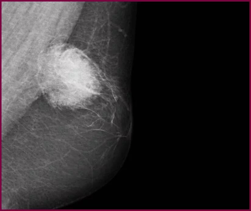 Рентген фиброза молочной железы. Фиброма молочной железы рентген.
