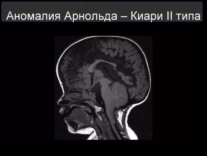 Аномалия Арнольда Киари 1 типа мрт головного мозга. Синдром Арнольда-Киари 1 степени. Аномалия Арнольда Киари типы.