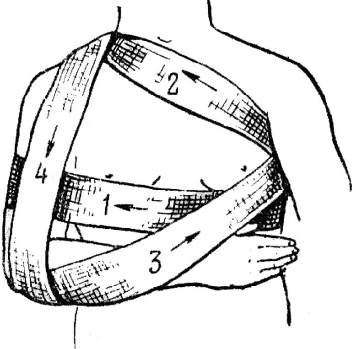 Повязка на руку схема. Повязка Дезо техника наложения. Схема наложения повязки Дезо. Технику наложения повязки Дезо.. Повязка Дезо на плечевой сустав техника.