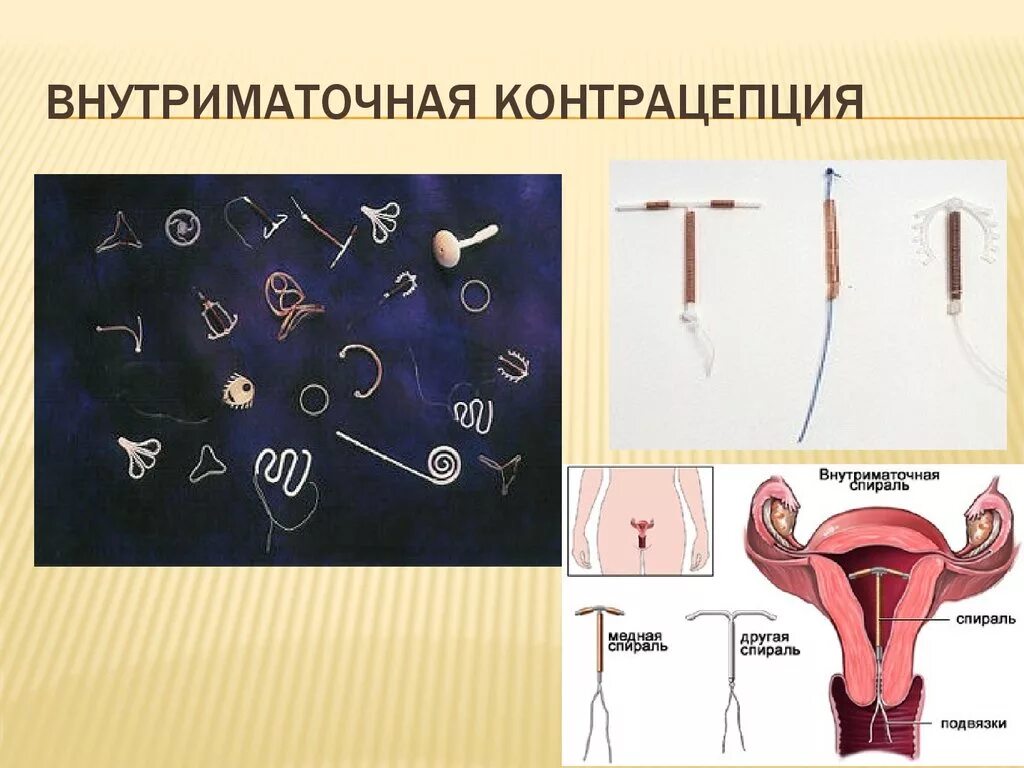 Контрацепция спираль внутриматочная. Метод контрацепции внутриматочная спираль. Внутриматочные контрацептивы (ВМК). Внутриматочная спираль методы контрацептивов.