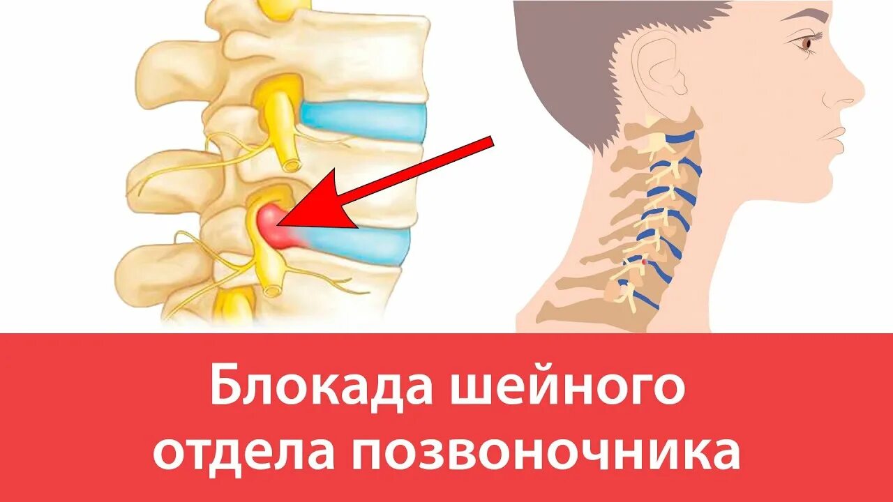 Блокада в шею. Блокада шейного позвонка. Паравертебральная блокада шейного отдела. Блокада при шейном остеохондрозе.