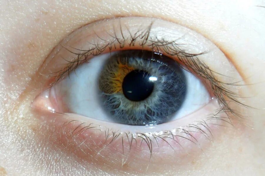 Пестрые глаза. Центральная гетерохромия глаз. Гетерохромия Радужки. Центральная гетерохромия карих глаз. Гетерохромия зеленый и Карий.