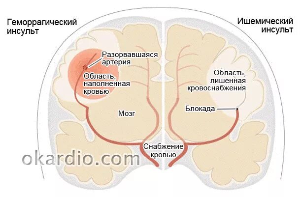 Геморрагический инсульт левого полушария. Инсульт левого полушария головного мозга. Инсульт в зависимости от локализации. Ишемический инсульт левого полушария.