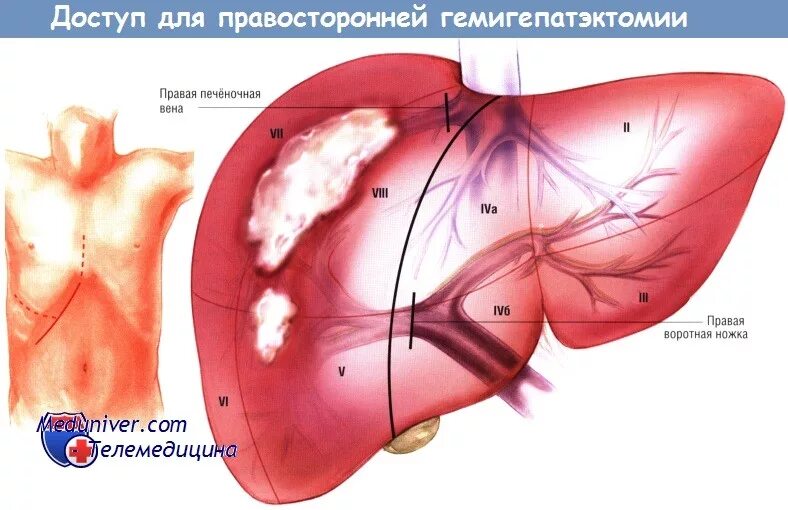 Операция резекция печени. Правосторонняя резекция печени. Расширенная левосторонняя гемигепатэктомия что. Правосторонняя гемигепатэктомия.