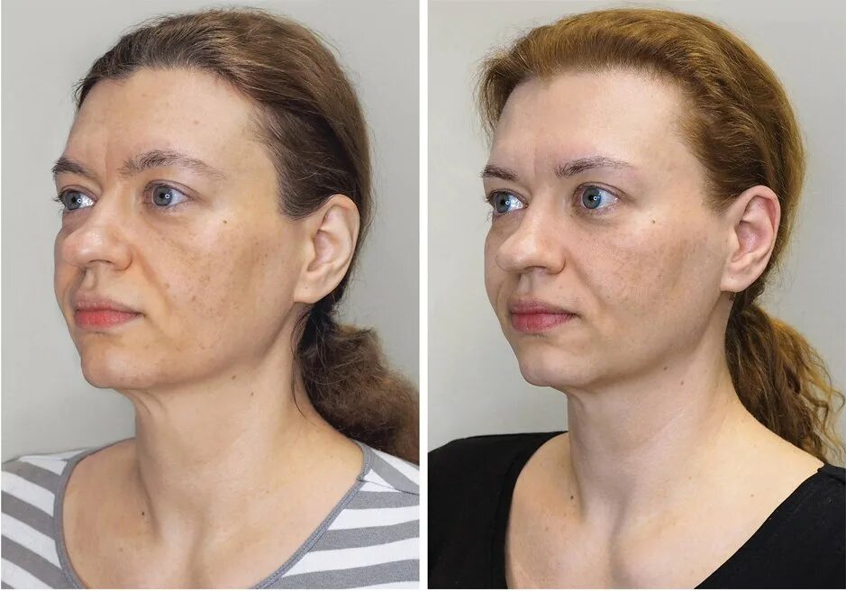 Осунулось лицо после похудения. Лицо до и после похудения. Скулы после похудения. Миофасциальный массаж лица до и после.