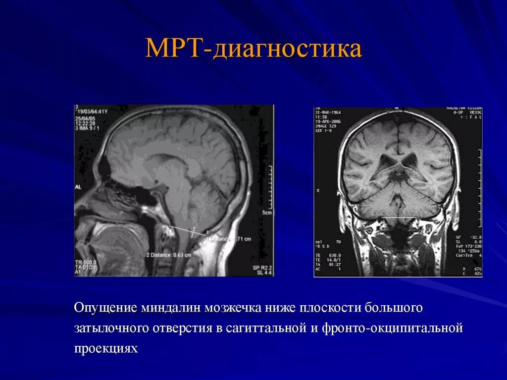 Опущение миндалин мозжечка мрт. Синдром арнольда киари 1 плода. Опущение мозжечка. Опущение мозжечка. Опущение мозжечка.