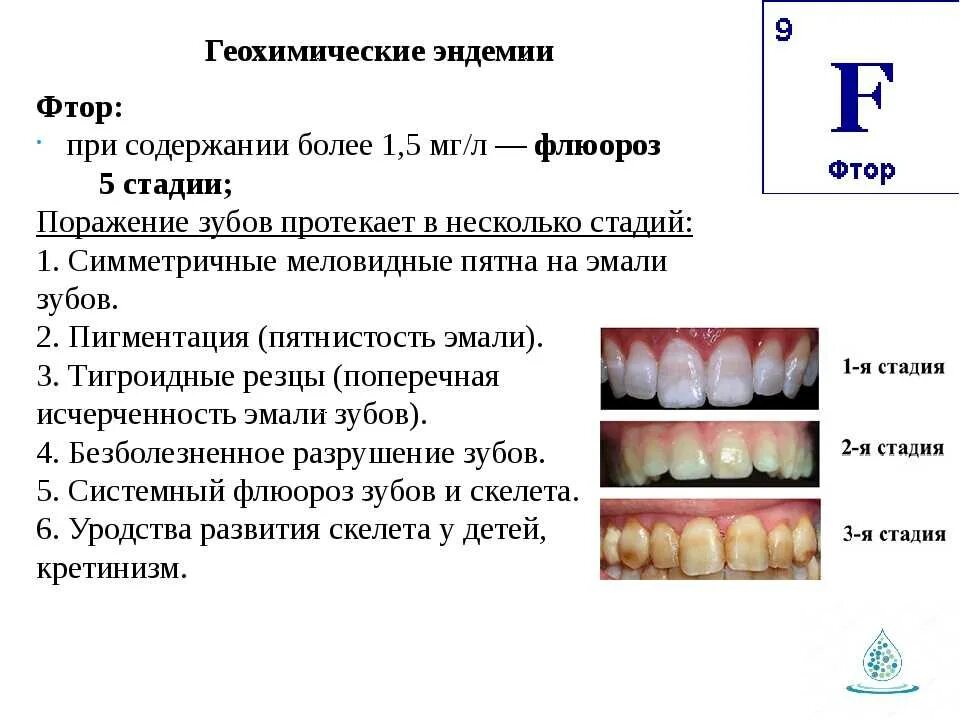 Переизбыток фтора. Эндемический флюороз зубов. Флюороз временных зубов. Меловидно-крапчатая форма флюороза зубов.. Эндемические заболевания флюороз.