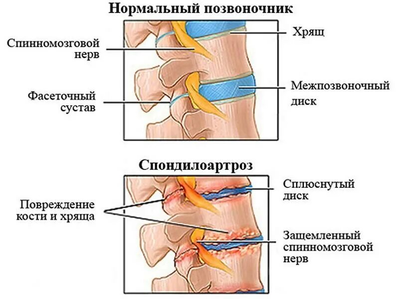 Как лечить поясничного отдела позвоночника. Спондилоартроз пояснично-крестцового отдела позвоночника. Спондилоартроз l1-s1 пояснично-крестцового отдела позвоночника. Спондилоартроз поясничного отдела l1-s1. Спондилоартроз l2-s1 что это такое.