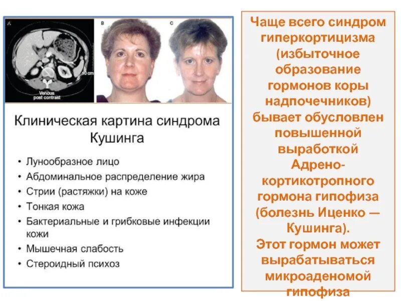 Гипофиза симптомы у женщин лечение прогноз. Аденома гипофиза симптомы у женщин. симптомы аденом гепофеза. опухоль гипофиза симптомы. опухоль гипофиза симптомы у женщин симптомы.