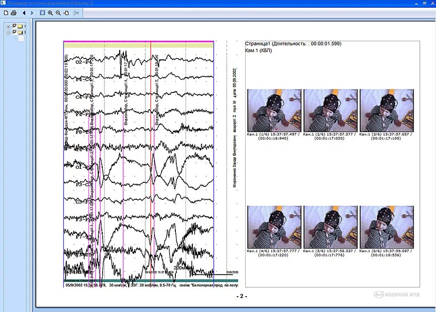 6 Часовой ЭЭГ мониторинг. ЭЭГ ночной мониторинг ребенку. Видеомониторинг ЭЭГ при эпилепсии. ЭЭГ ночное мониторирование сна. Ээг дневное ребенку