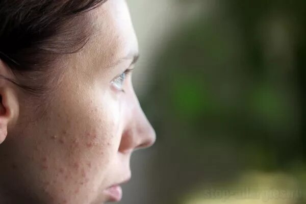 В ухе возникают аллергические реакции. Аллергические прыщи на лице.