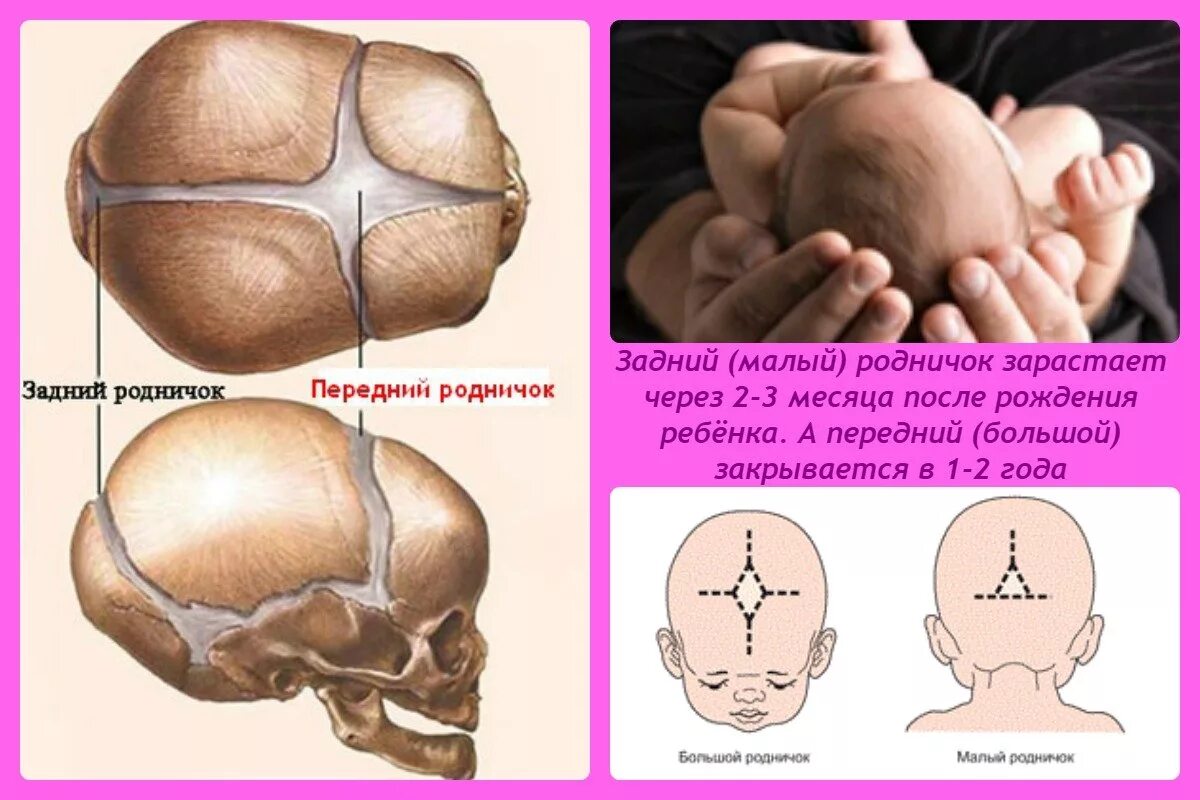 Мозг новорожденного норма. Малый Родничок у новорожденных норма. Большой и малый Родничок у новорожденного. Малый Родничок и большой Родничок. Передний большой Родничок.