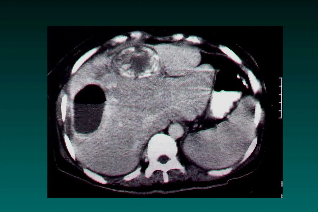 Паразитарная киста печени. Гидатидная киста печени СКТ. Эхинококковая киста печени кт. Кисты печени кт эхинококкоз.