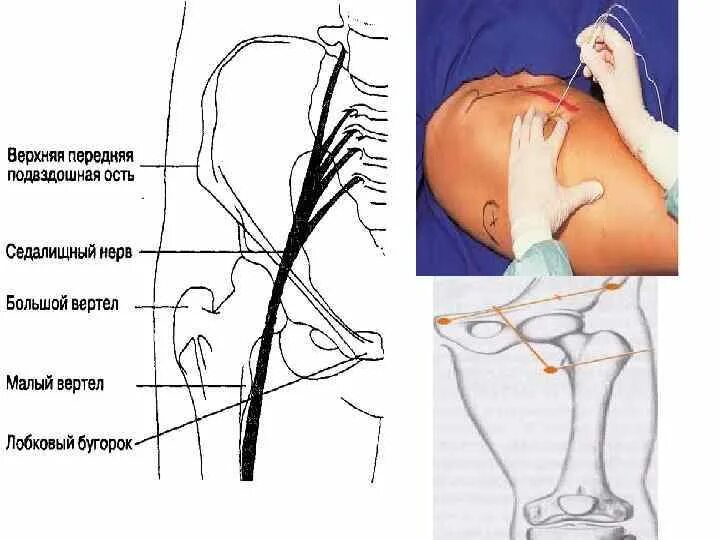 Что будет если попасть в седалищный нерв. Блокада седалищного нерва анестезия. Блокада седалищного нерва техника. Схема блокады седалищного нерва. Техника блокады седалищного нерва по Войно-Ясенецкому.