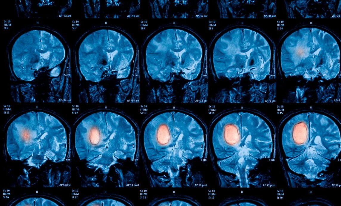Рак мозга сколько стадий. Глиобластома головного мозга. Опухоль головного мозга глиобластома 4. Злокачественная глиобластома головного мозга снимок.