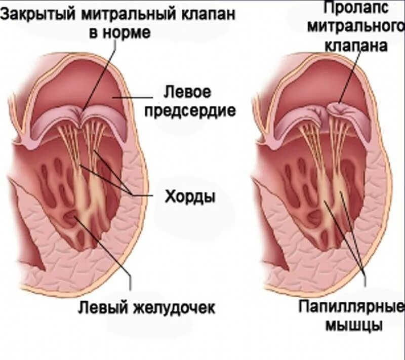 Пмк 1 степени что это такое. Пролапс митрального клапана. пролапс митрального клапана 2 степени. пролапс передней створки митрального клапана. пропакс мистральрооо клапана.