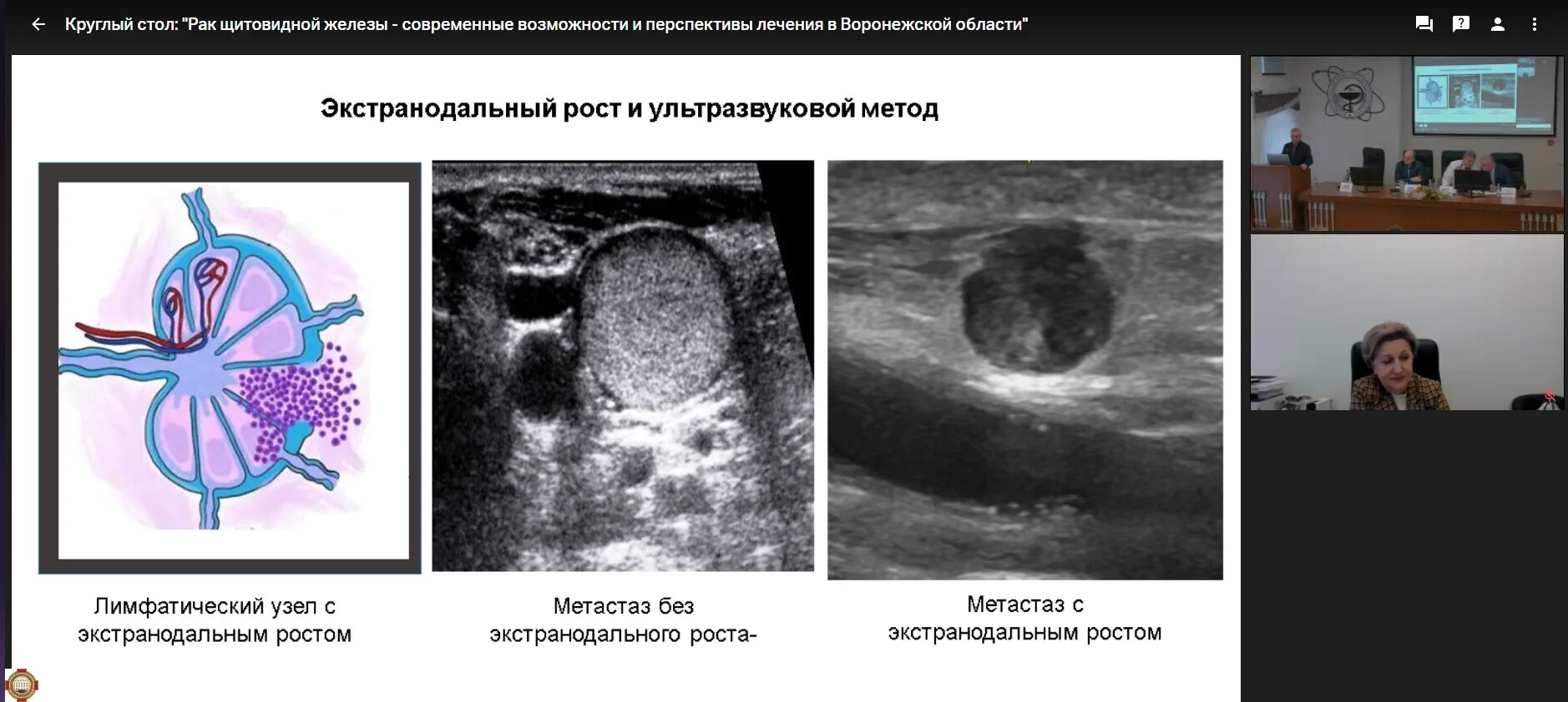 Метастазы при раке щитовидной железы. Анапластическая карцинома щитовидной. Анапластическая карцинома щитовидной железы фото. Папиллярная карцинома щитовидной железы контроль после операции. Столы онкология.