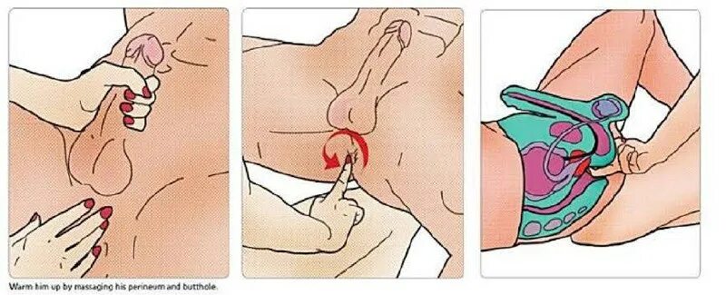 Como se hace una ecografia de prostata