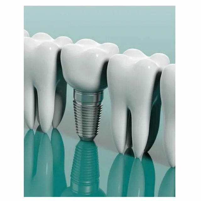 Dentsply sirona имплантат astra tech. швейцарские импланты штрауман. израильский имплант «mis». имплантат r4206. имплантат осстем абатмент.