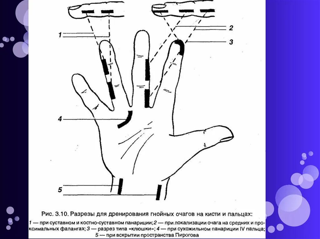 Комиссуральная флегмона кисти. Разрезы при флегмонах кисти. Комиссуральная флегмона кисти. Разрезы на кисти. Линии разрезов кожи при вскрытии флегмон кисти.