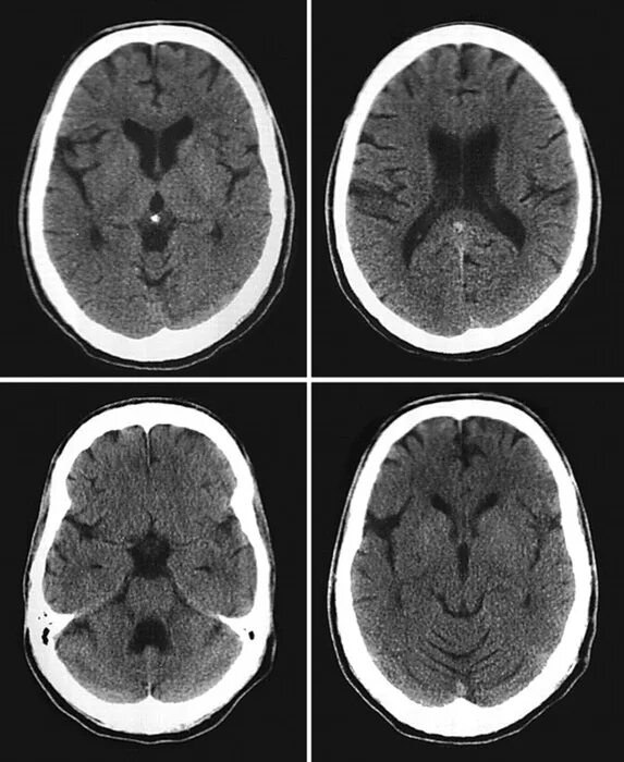 Кт головы москва. Кт томограмма головного мозга. Компьютерная томография кт головного мозга. Рентгеновская компьютерная томография головного мозга. Компьютерная томография головного мозга норма.