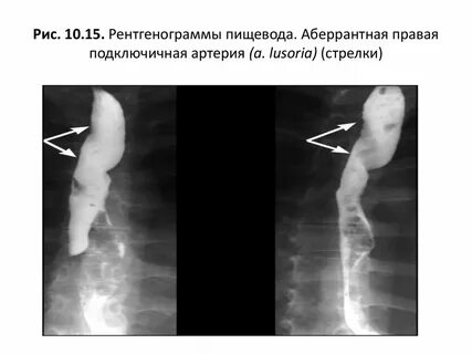 Аберрантная правая подключичная артерия у плода