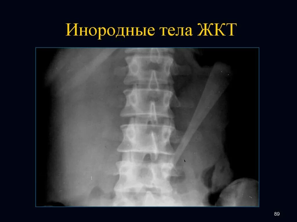 Инородное тело в желудке у ребенка симптомы. Инородные предметы на рентгене. Инородные тела желудочно-кишечного тракта. Инородные тела пищеварительного тракта рентген. Инородные тела желудочного тракта.