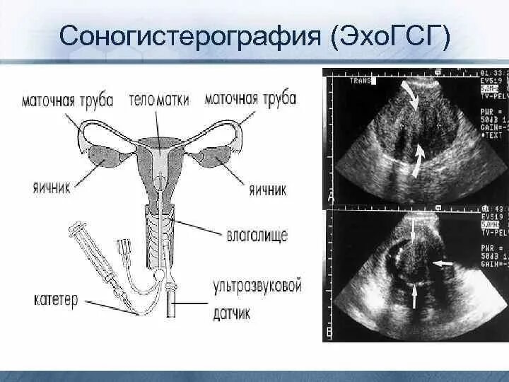 Эхо трубы. Эхо УЗИ проходимости маточных труб. Гидросонография маточных.