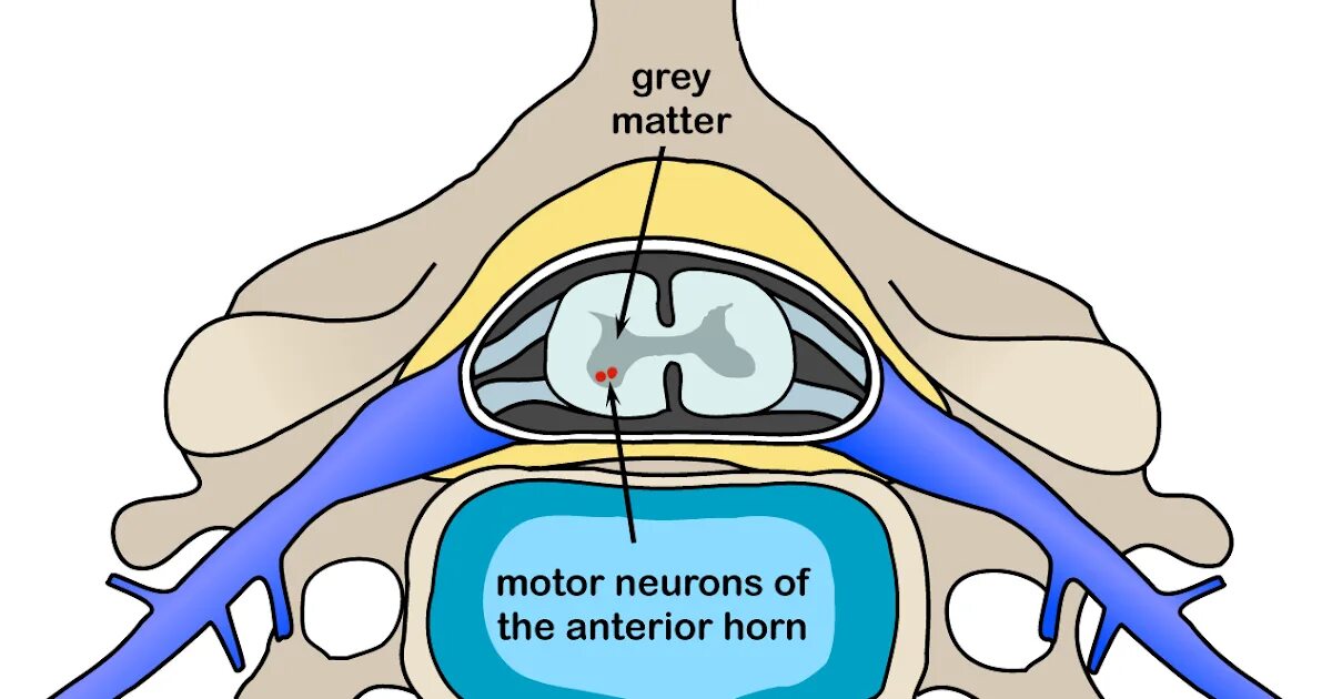 циркулярные протрузии дисков с3-с4. протрузии дисков позвоночника шейного отдела. экструзия межпозвоночного диска шейного. протрузии экструзии межпозвонковых дисков. экструзия межпозвоночного диска шейного.
