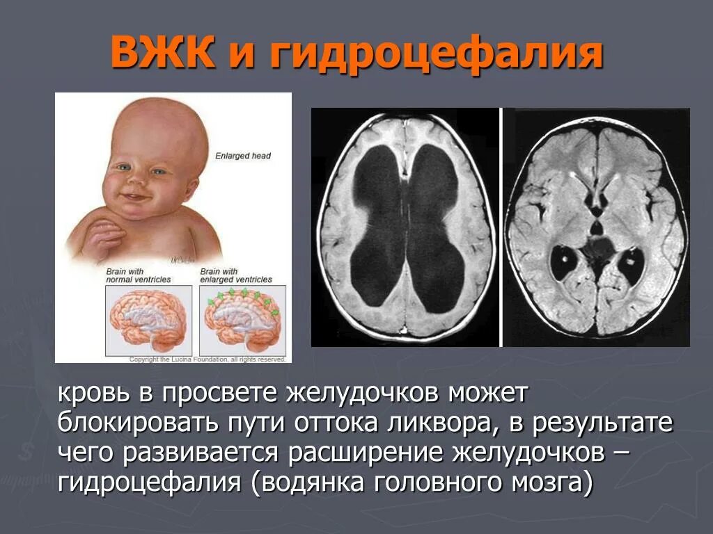 Дилатация бокового желудочка мозга. Гидроцефалия норма желудочков. Гидроцефалия 4 степени. Врожденная гидроцефалия. Водянка желудочков головного мозга.