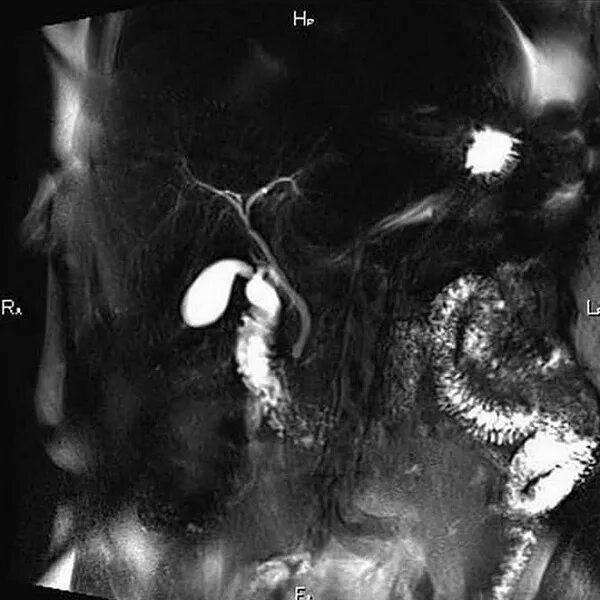 Магнитно-резонансная холангиография желчного пузыря. Магнитно резонансная холангиопанкреатография МРХПГ. Мрт желчных протоков холангиография. Мрт с холангиографией брюшной полости что это такое.