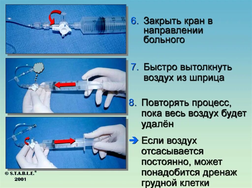 Почему выходит воздух через. Воздух в шприце. Шприц для дренажа. Воздух из шприца. Воздух в Вену через шприц.