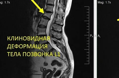 Дегенеративные изменения пояснично крестцового отдела что это