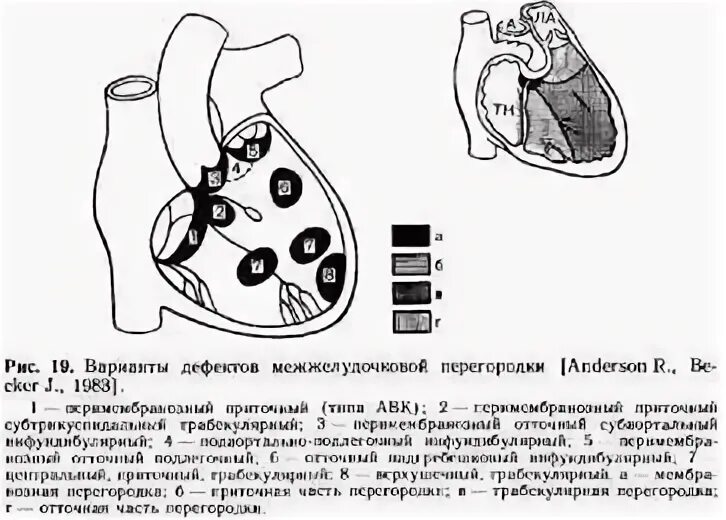 Код мкб дмжп у детей. Мышечный трабекулярный дефект межжелудочковой перегородки. дмжп мембранозной части. типы дефектов межжелудочковой перегородки. мембранозная часть межжелудочковой перегородки.
