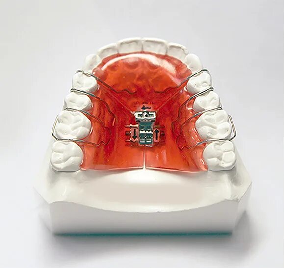 аппарат бенефит ортодонтия. винты на верхнюю челюсть. винты на верхнюю челюсть. винты на верхнюю челюсть. ортодонтический винт бертони.