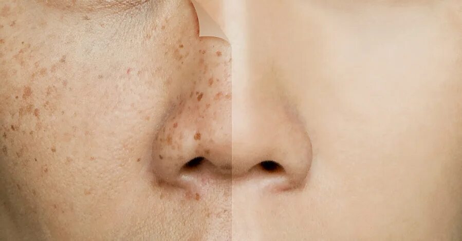 Осветление пигментных пятен на лице. Отбеливание кожи от пигментации. Фотоудаление пигментных пятен. Как осветлить пигментные пятна. Мелазма пигментные пятна.