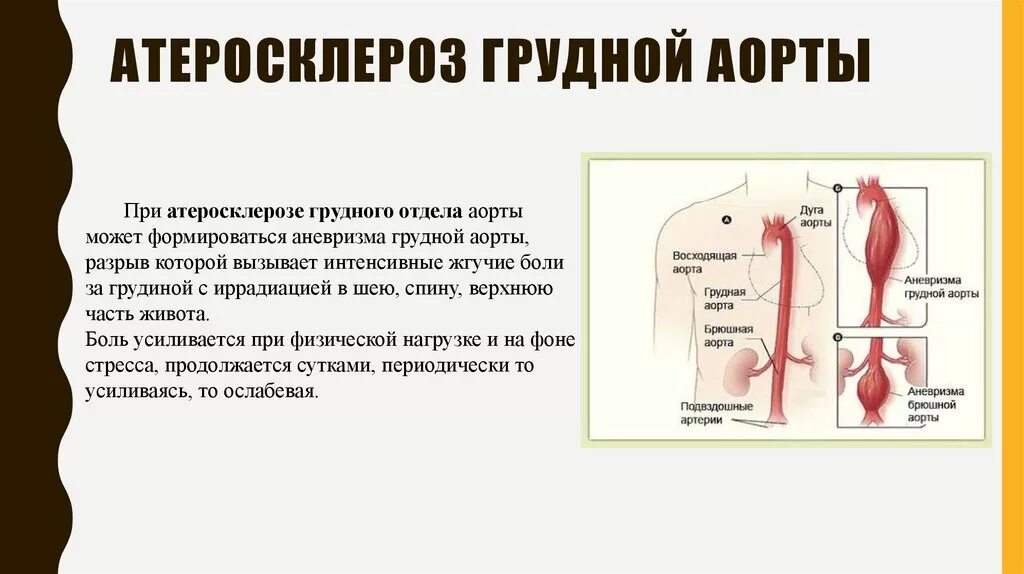 Атеросклероз грудного отдела аорты. Атеросклероз грудного отдела аорты и коронарных артерий. Атеросклероз брюшной аорты клиника. Клинические проявления атеросклероза аорты.