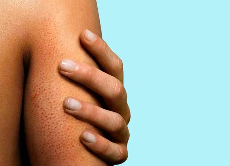 Мелкая бесцветная сыпь. Фолликулярный гиперкератоз. Фолликулярный кератоз на ногах. Фолликулярной кератозп. Фолликулярный гиперкератоз гусиная кожа.