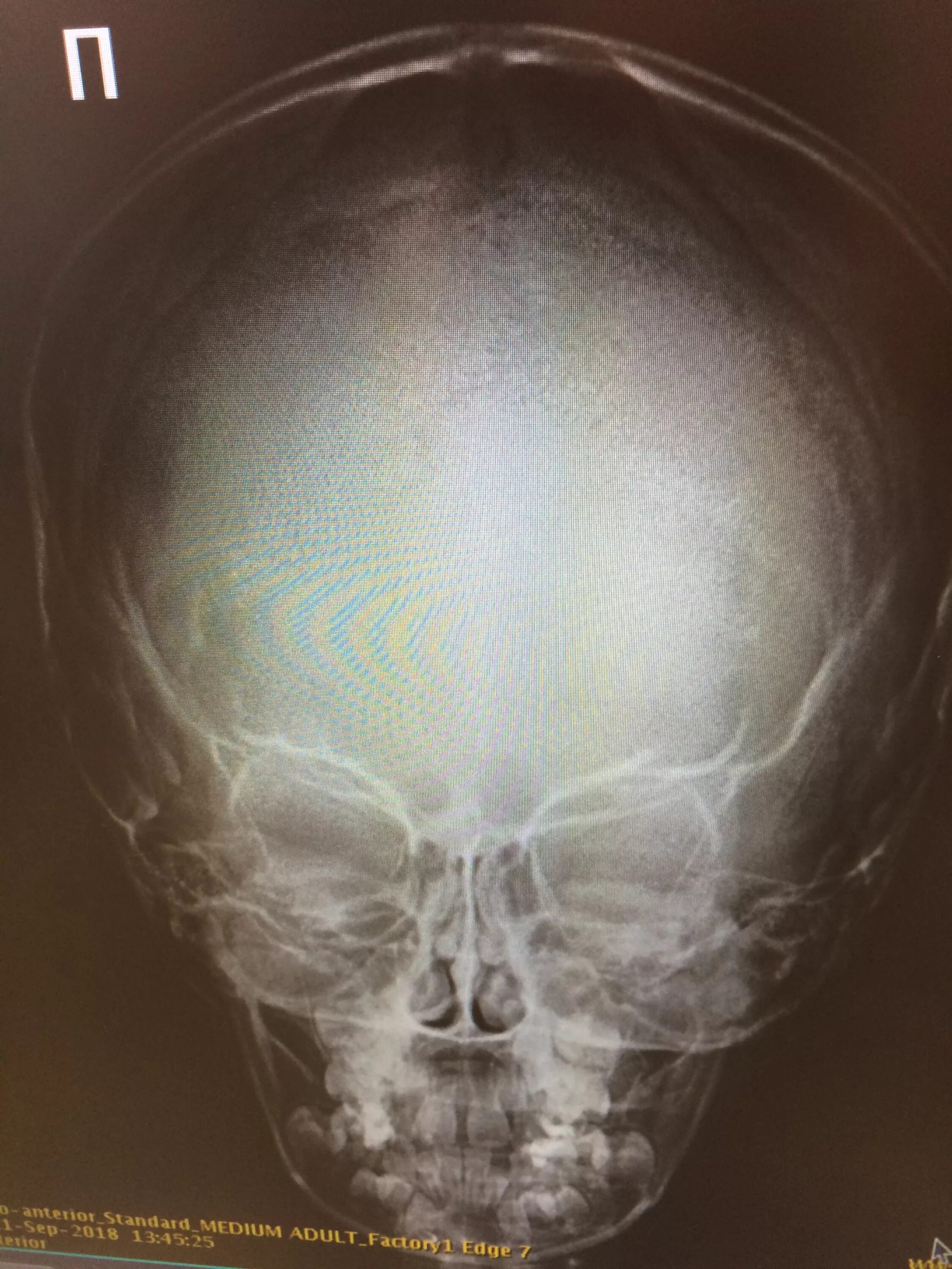 Пахионовы грануляции рентген черепа. Рентген черепа Кеннеди.