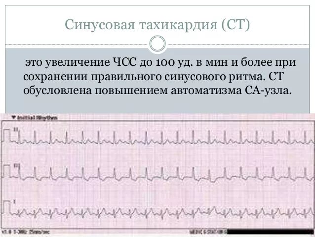 Признаки тахикардии у женщин симптомы. Синусовая тахикардия чсс 100 экг. синусовая тахикардия у ребенка 1 год. синусовая тахикардия экг признаки. синусовая тахикардия чсс 125.