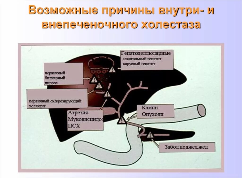 Причины внепеченочного холестаза. Внутри и внепеченочный холестаз. Причинами гепатоцеллюлярного холестаза являются. Укажите причины внепеченочного холестаза.