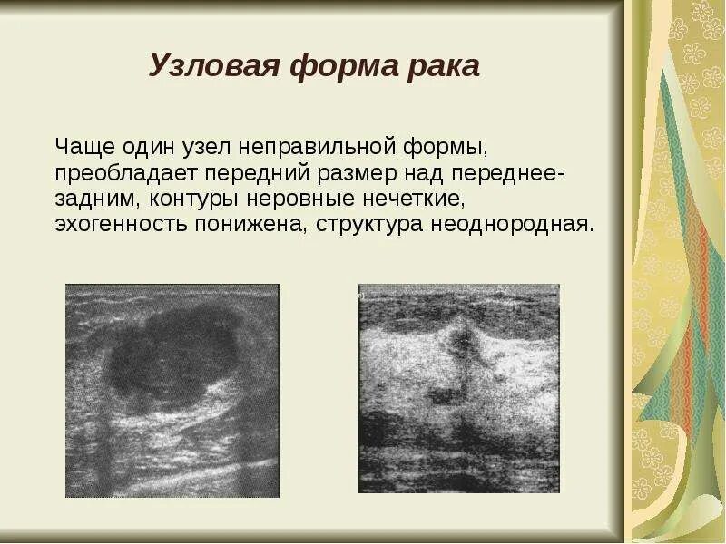 Отечная форма рака молочной. Узловая опухоль молочной железы. узловая карцинома молочной железы. узловая формарак молочной железы.