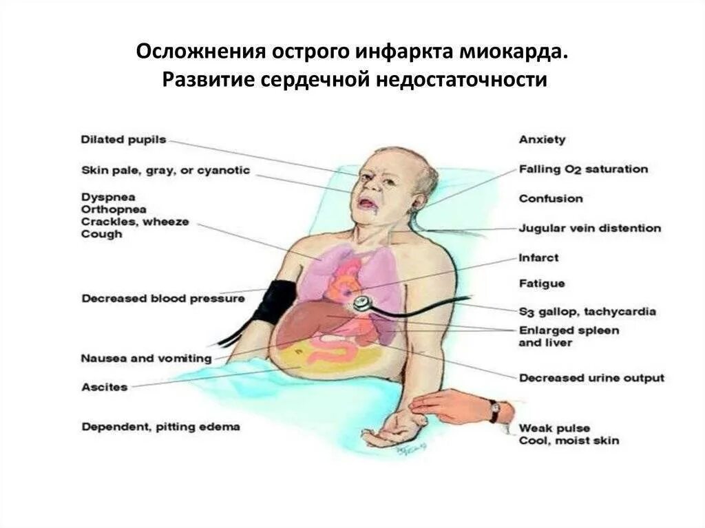 Возможные осложнения при инфаркте миокарда. Осложнения острого инфаркта миокарда. Осложнение инфарк миокарда. Осложнения инфакртам имокарда. Муж после инфаркта