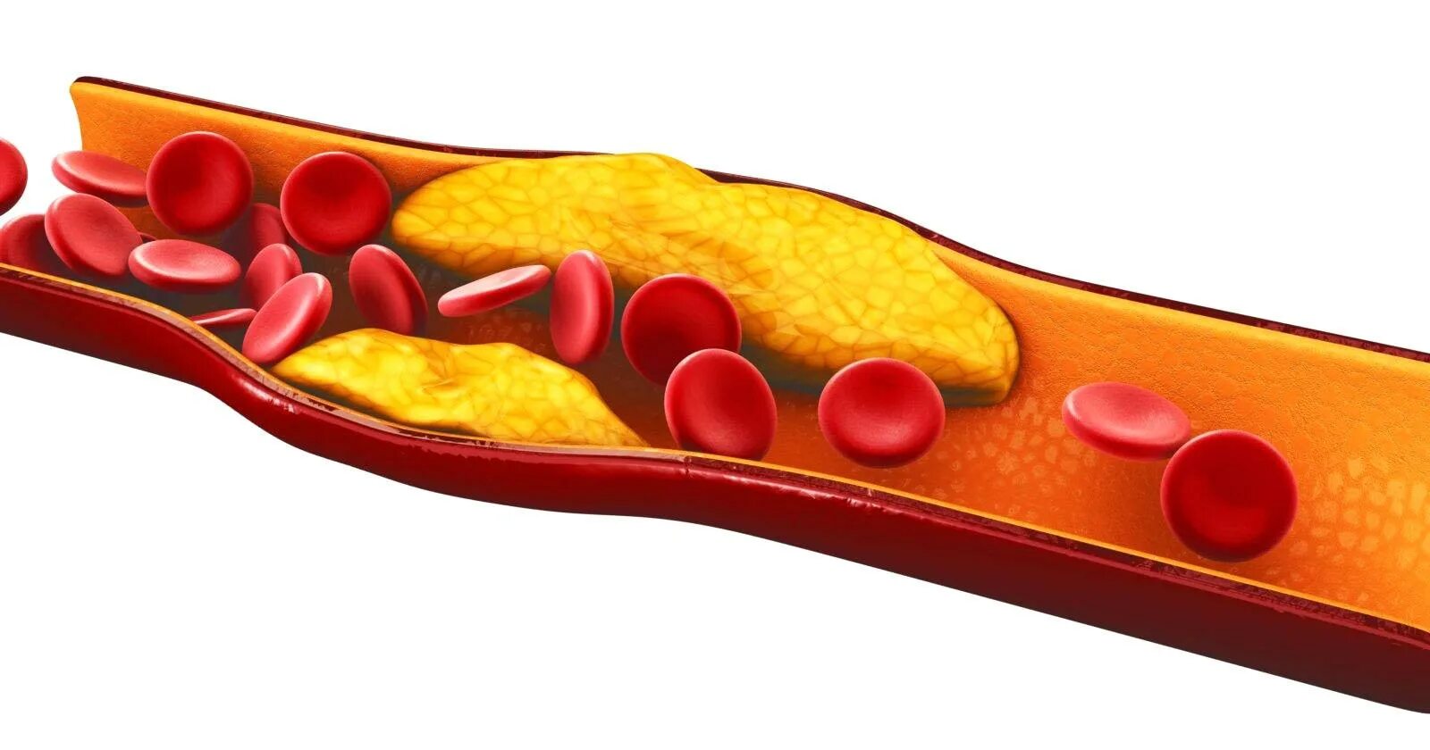 Влияние холестерина в крови. Холестерин. Холестерин картинки. Повышенный уровень холестерина. Холестерин на прозрачном фоне.