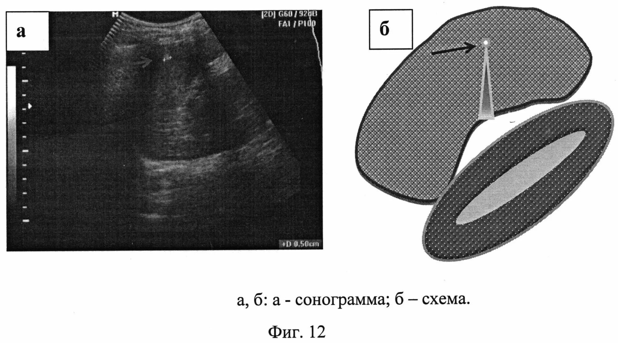 Туберкулез селезенки на УЗИ. Туберкулез печени и селезенки. УЗИ плевральной полости.