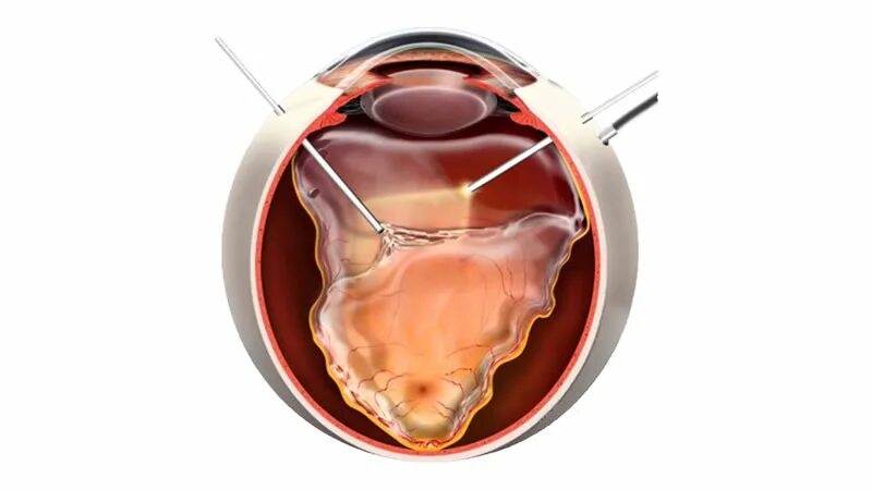 Витрэктомия отслоение сетчатки. Отслойка сетчатки витрэктомия. Витрэктомия ретинопатия.