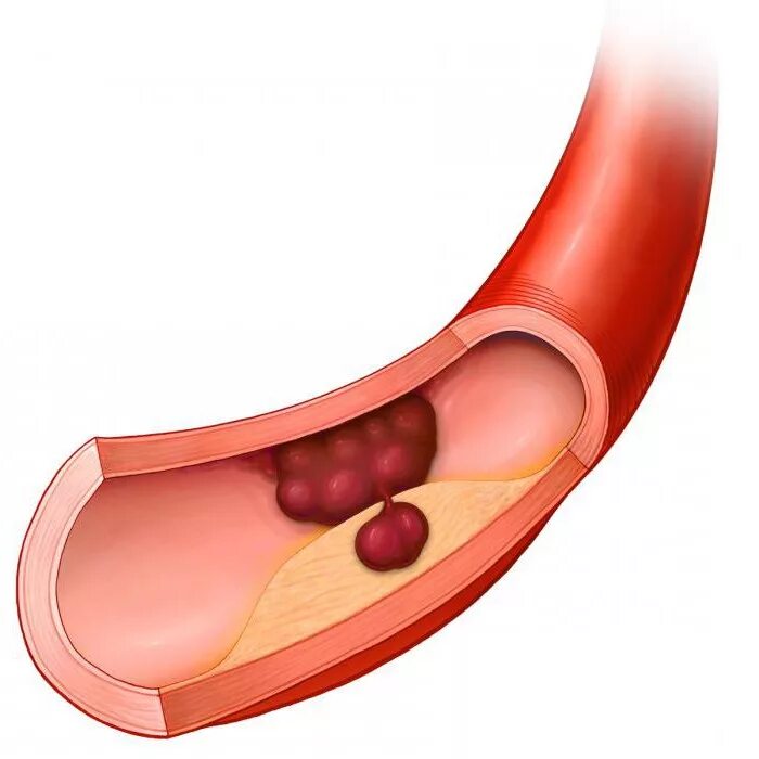 Кальциноз при атеросклероз сосудов атеросклерозе. Тромб в кровеносном сосуде. Атеросклеротическое поражение кровеносных сосудов. Атеросклероз холестериновая бляшка. Атеросклероз тромбоз сосудов.