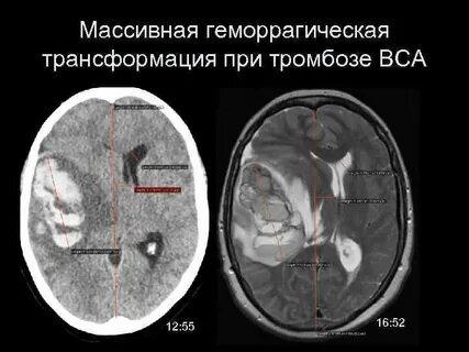 Геморрагическая трансформация ишемического инсульта