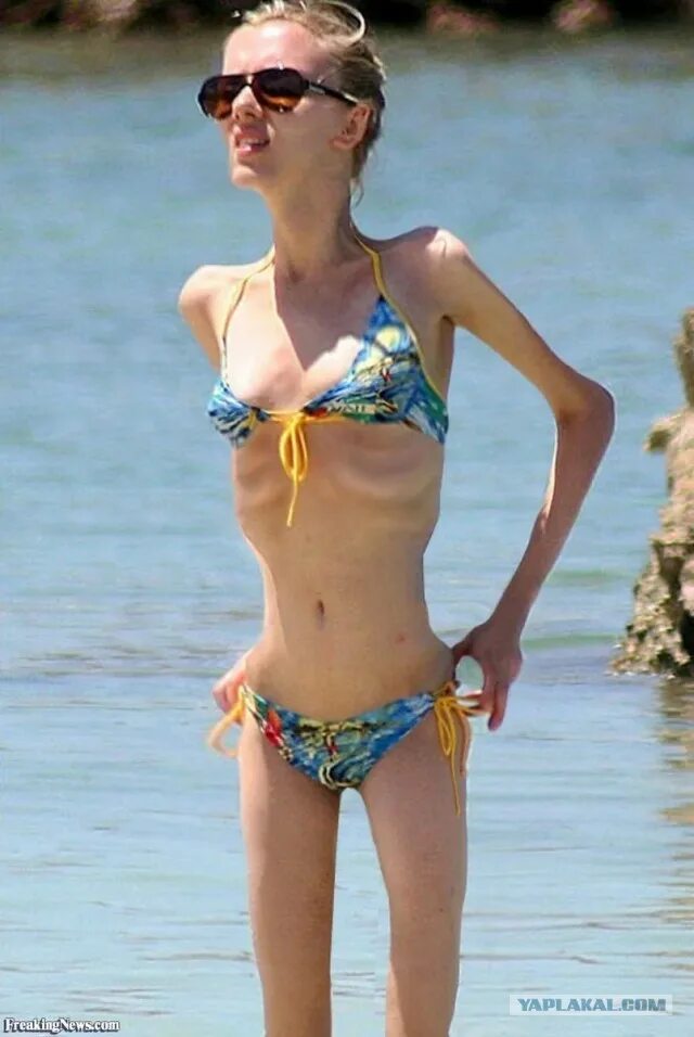 хайди гюнтер анорексия. очень сильно худая девушка. николь ричи худоба. анна жолобова анорексия. виктория приходько анорексия.