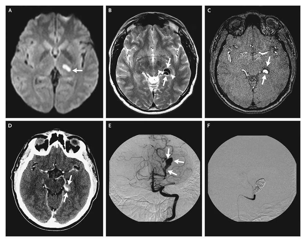 Тромбоз артерии головного мозга на мрт. Тромбоз средней мозговой артерии мрт. Аневризма головного мозга на кт. Аневризма мозговой артерии. Тромбоз мозговых сосудов
